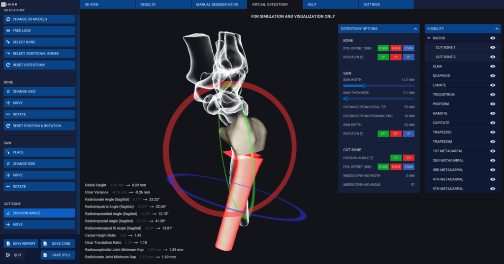 osteotomy-2-6_orig Image